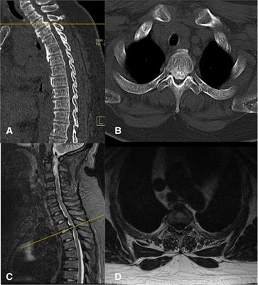 “Cave-in” decompression under unilateral biportal endoscopy in a patient with upper thoracic ossification of posterior longitudinal ligament: Case report